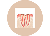 C４  歯根まで進んだ虫歯