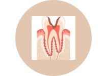 C３  神経まで進んだ虫歯（歯髄）