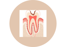 C２  象牙質の虫歯（神経に近い）