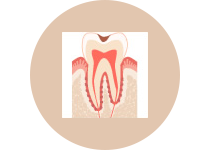 C１  エナメル質の虫歯（歯の表面）